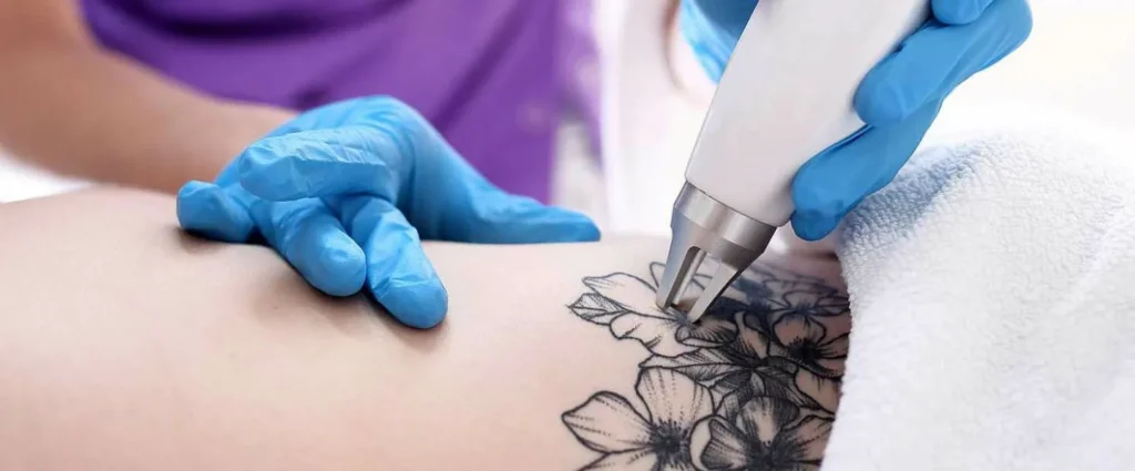 tattoo removal near me